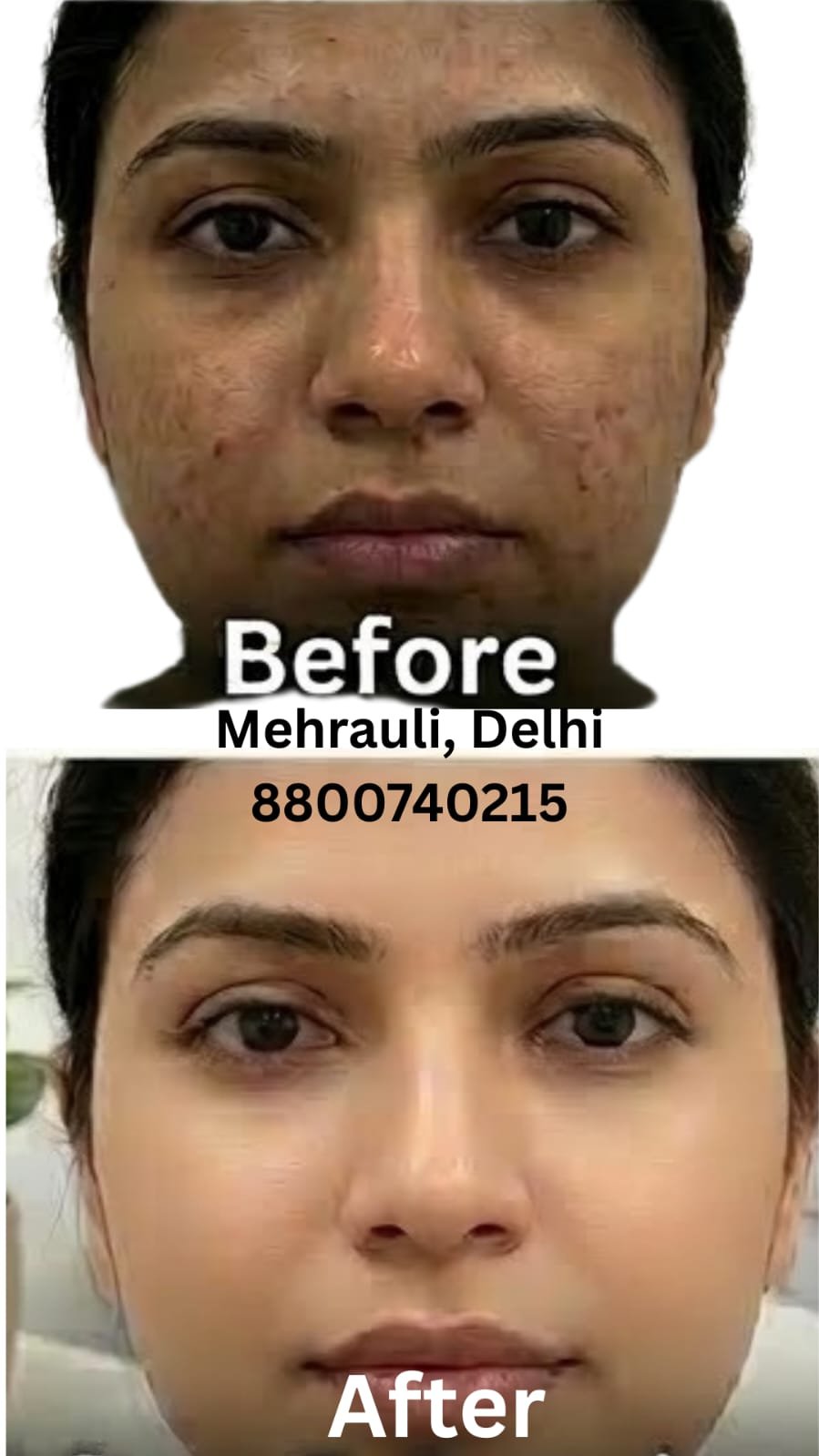 BB Glow Facial treatment in Delhi