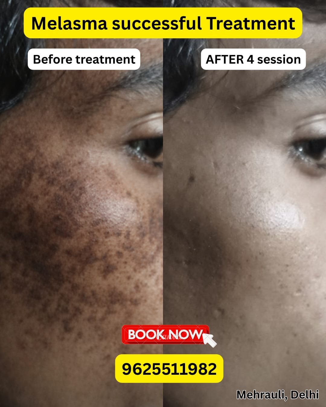 Melasma before after treatment result