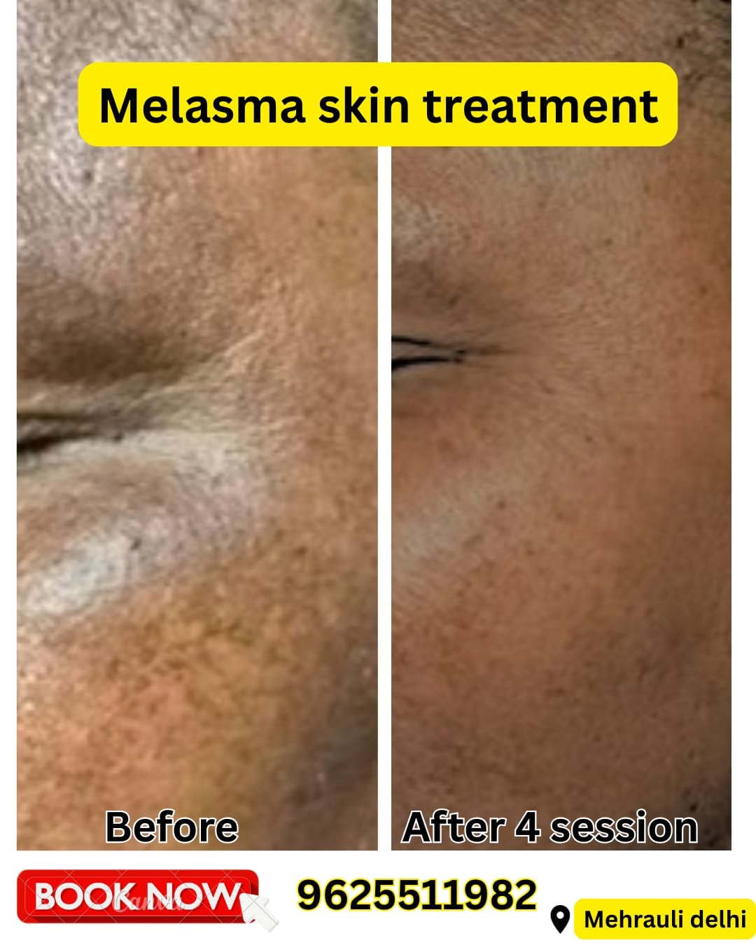 Melasma skin treatment result