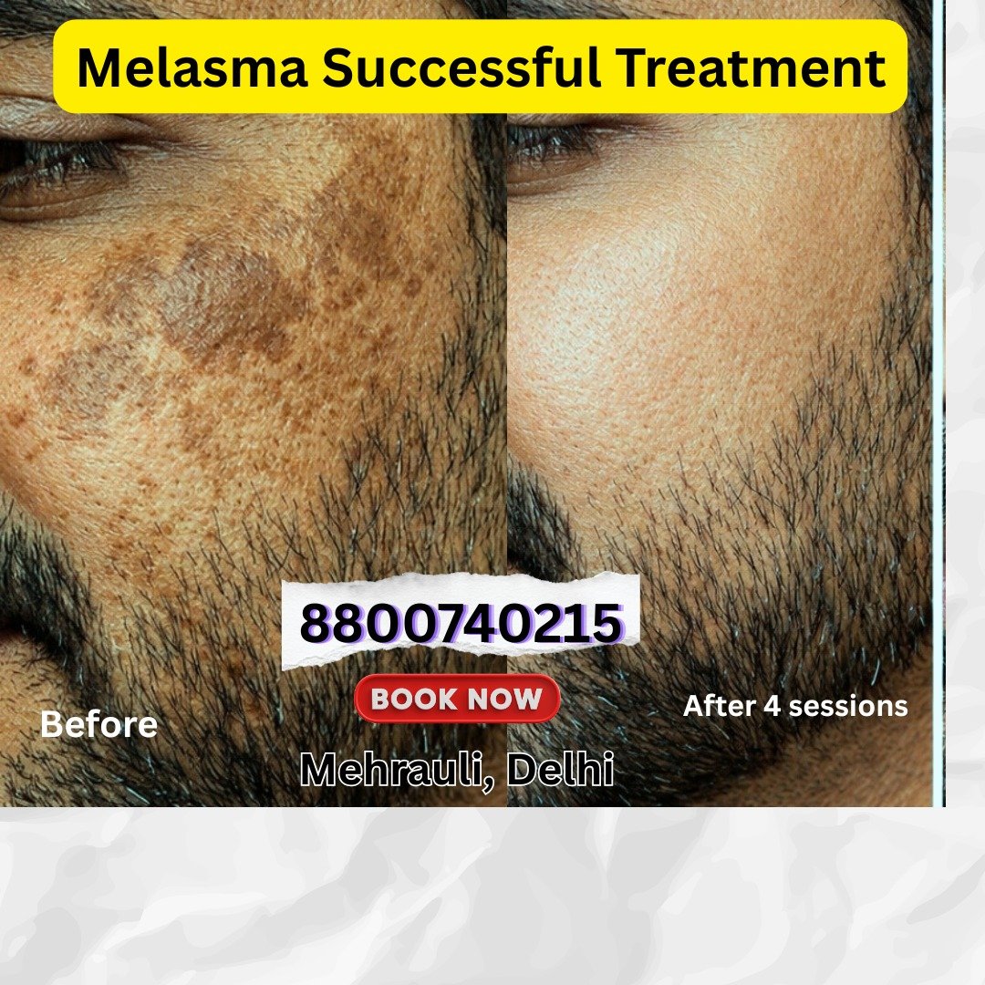 Melasma pigmentation treatment result