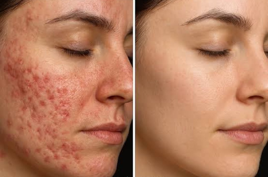 Melasma treatment improvement result