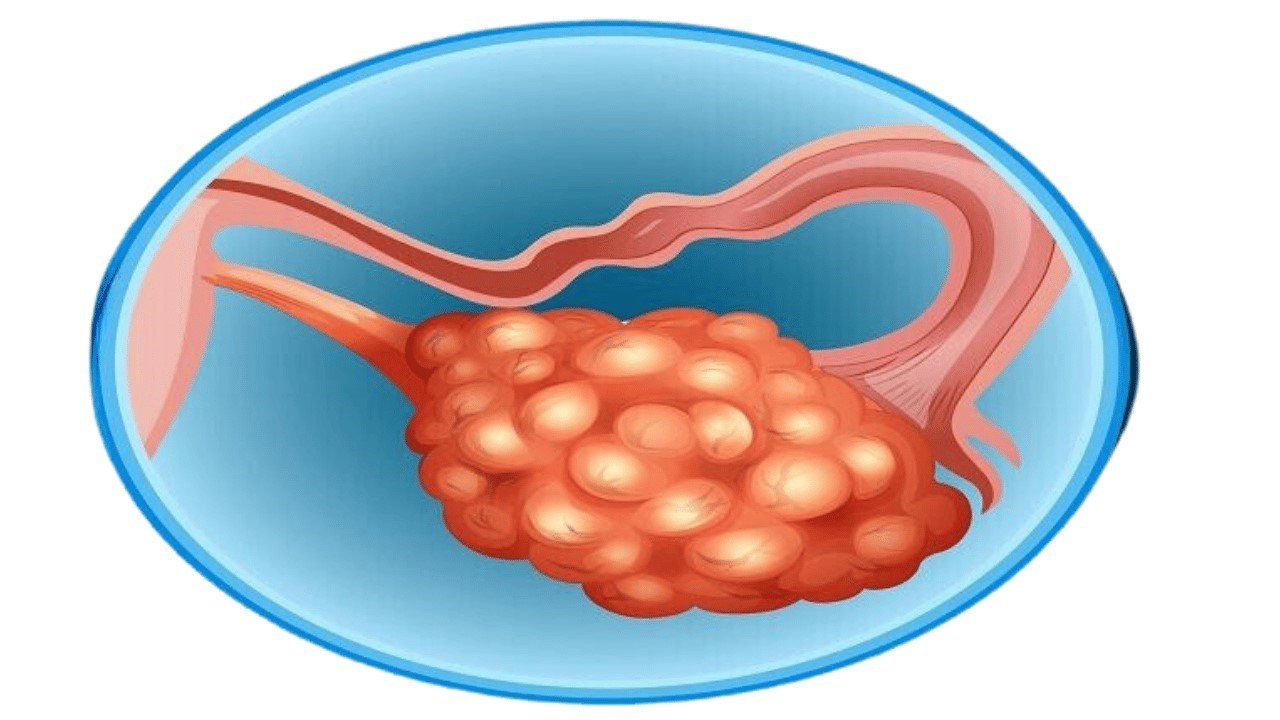 PCOS infertility treatment