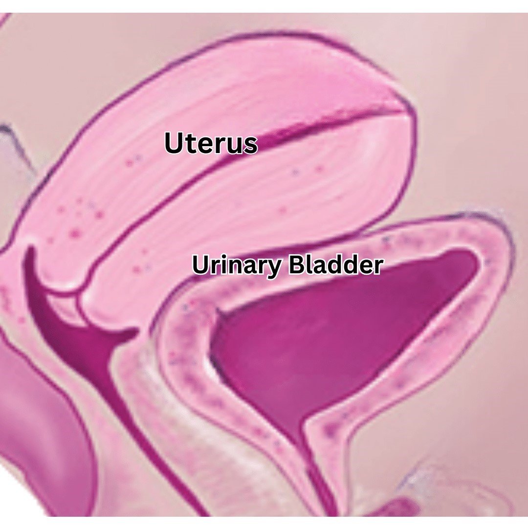 Pelvic Inflammatory Disease (PID) - Exploring causes and management with insights from Dr. Shabnam Sharjil at PCOS Ferticure Clinic for effective treatment and care in the context of PCOS-PCOD.