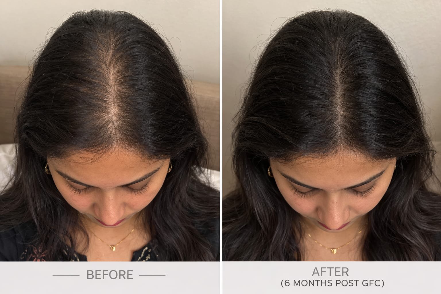 PRP hair treatment after hair density improvement in Delhi