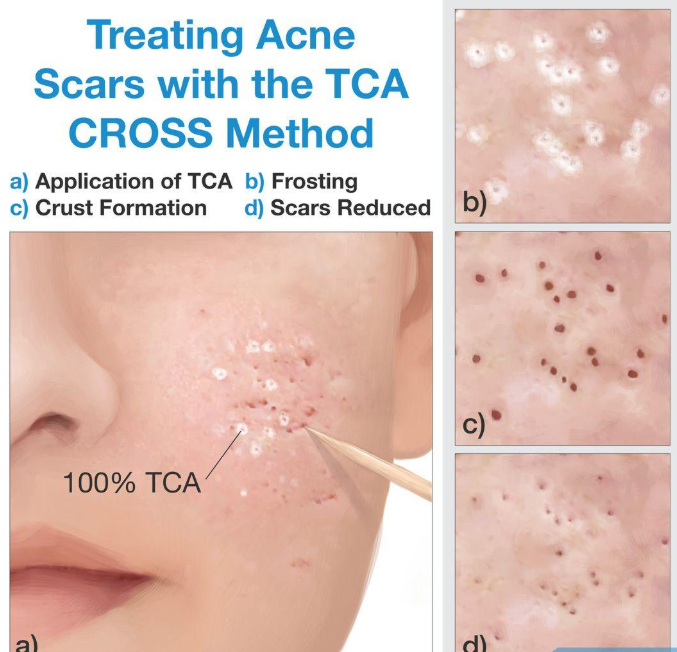 TCA cross acne scar treatment