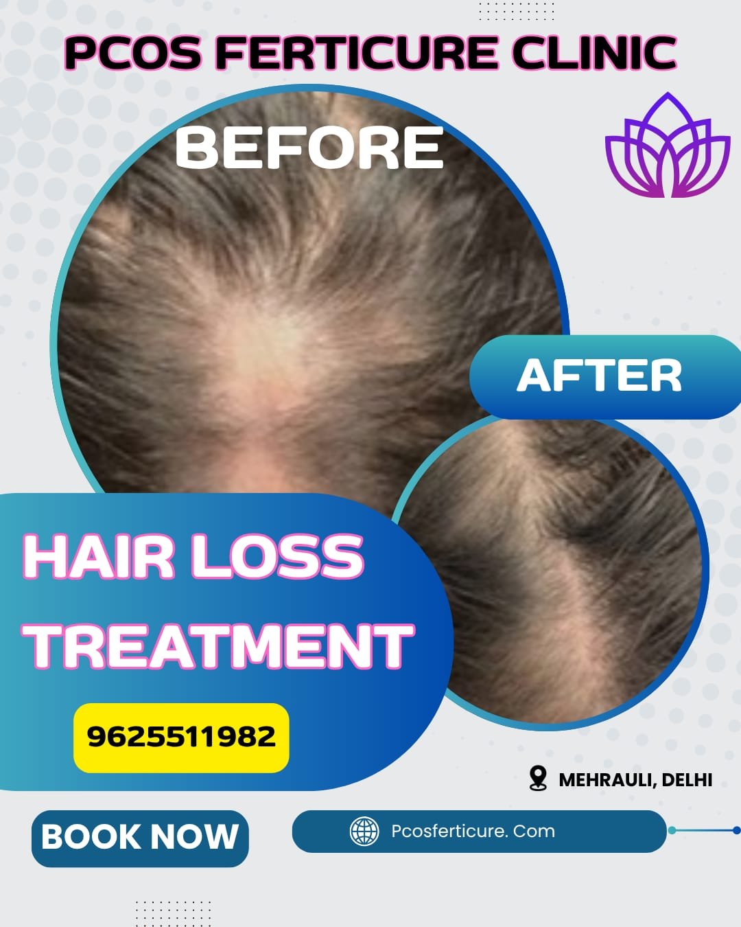 PRP hair loss treatment result