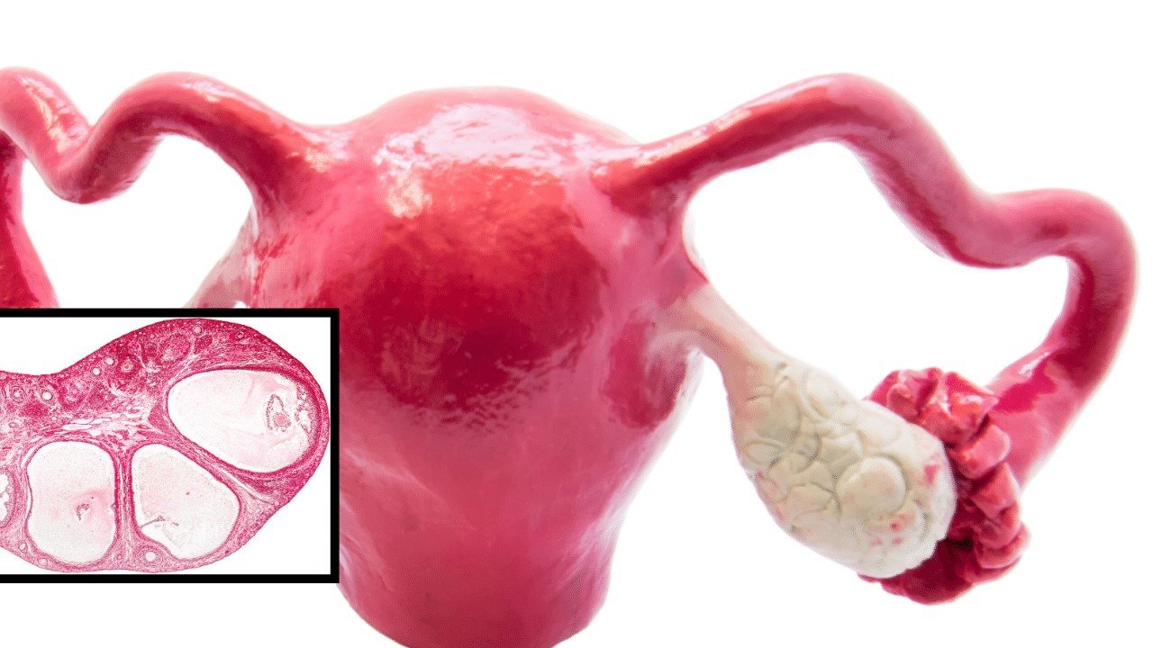 PCOS Ferticure clinic