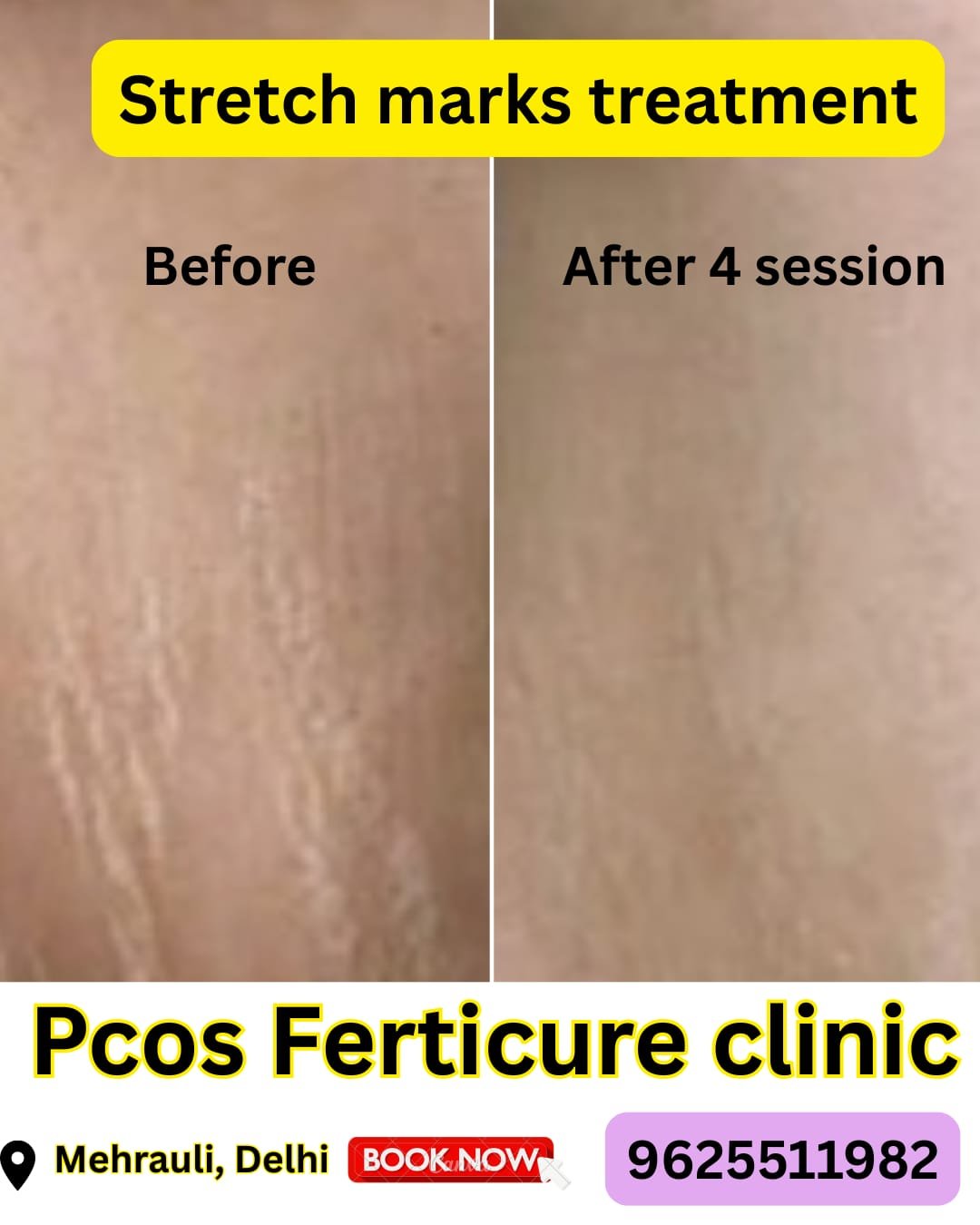 Stretch mark treatment result