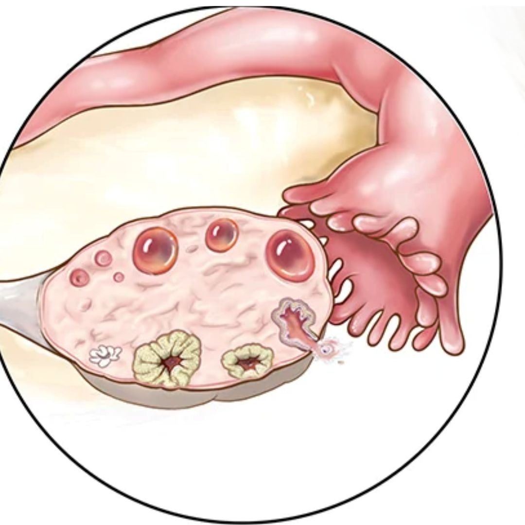 Healthy ovary - Illustration representing the positive outcomes of PCOS-PCOD treatment by Dr. Shabnam Sharjil at PCOS Ferticure Clinic.