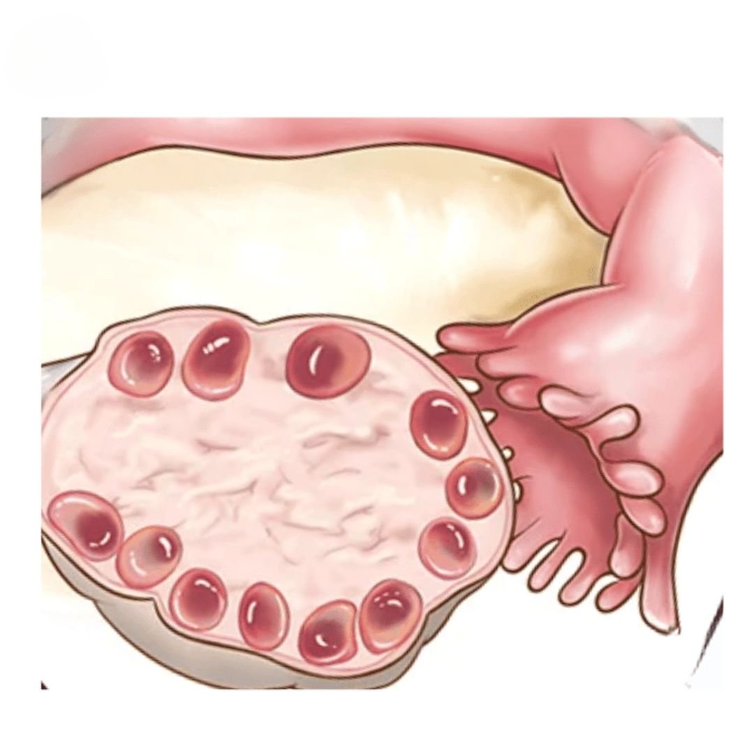 PCOS-affected ovary - Visual representation of the impact of PCOS, highlighting the need for effective PCOS-PCOD treatment by Dr. Shabnam Sharjil at PCOS Ferticure Clinic.