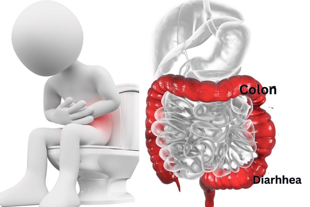 Understanding Bowel Endometriosis - Dr. Shabnam Sharjil at PCOS Ferticure Clinic provides expert insights on bowel endometriosis. Explore comprehensive information, expert knowledge, and strategies for managing bowel-related symptoms within the context of women's health and endometriosis.