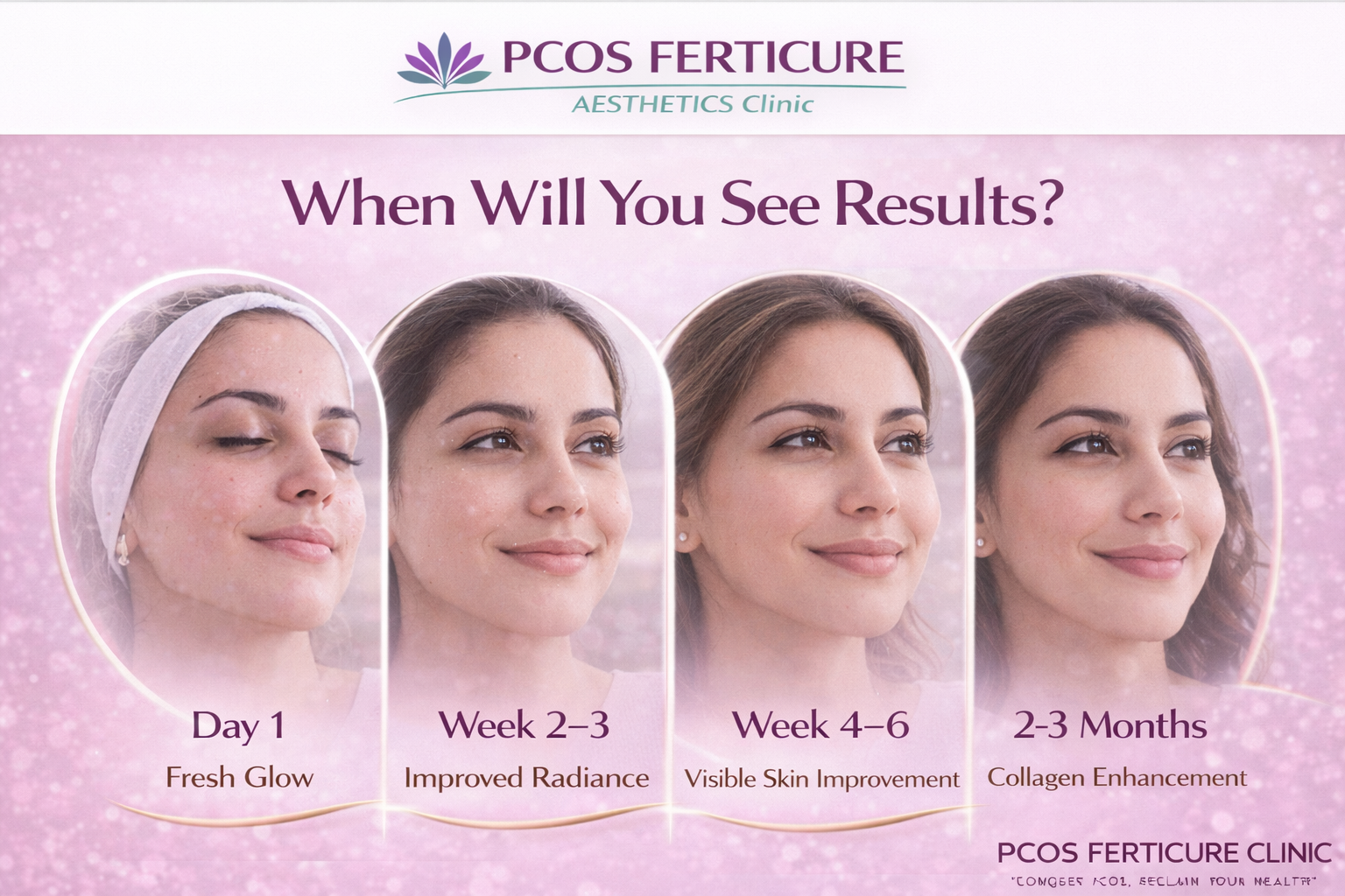 Timeline showing PRP facial treatment results including glow in 1-2 weeks, texture improvement in 4-6 weeks and collagen enhancement after 2-3 sessions - PCOS Ferticure Clinic Delhi
