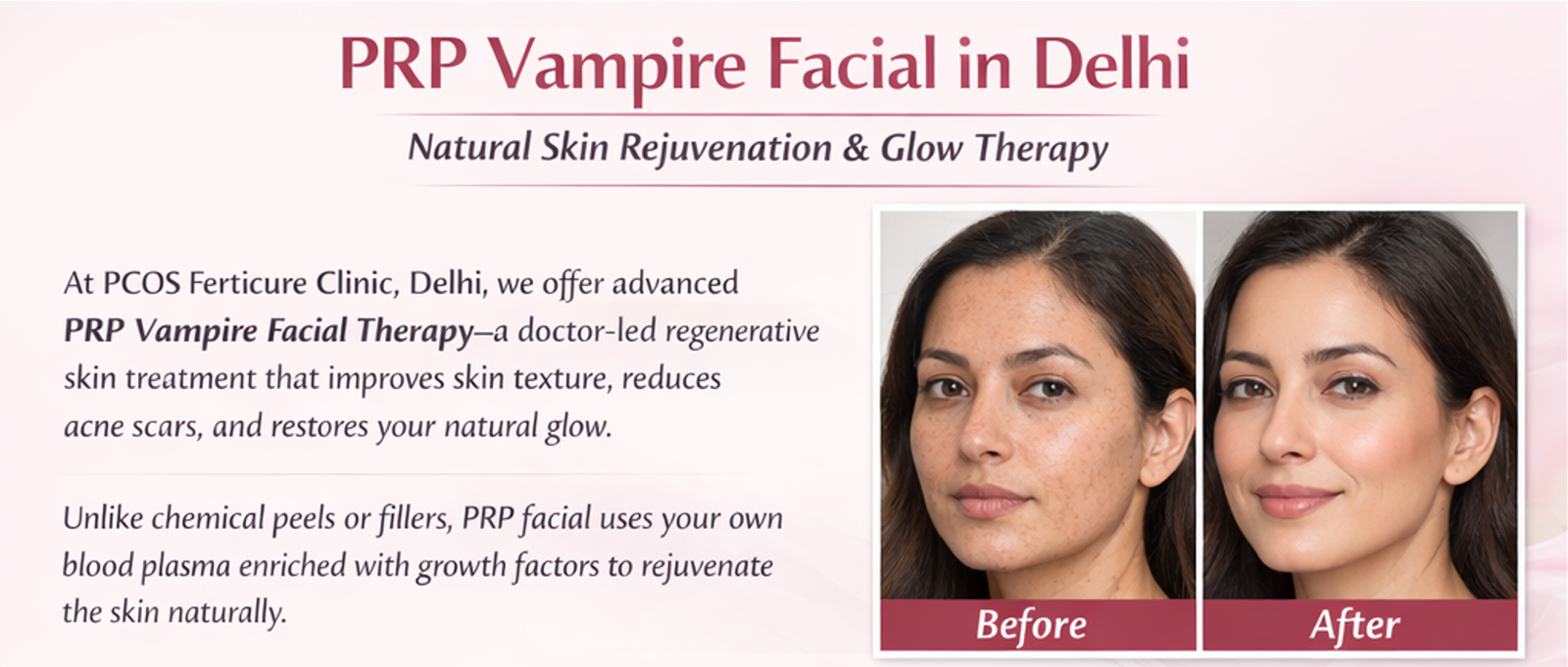 Before PRP vampire facial showing dull skin and acne scars